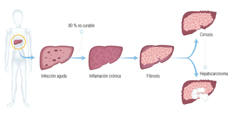 Complicaciones de la hepatitis c