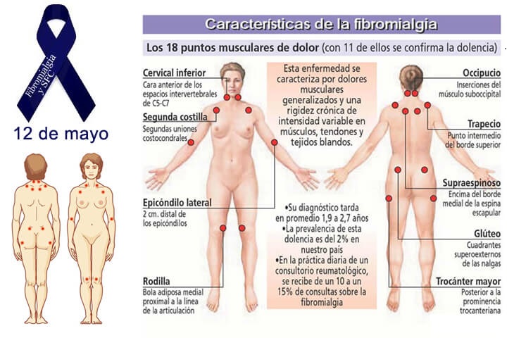 características de la fibromialgia