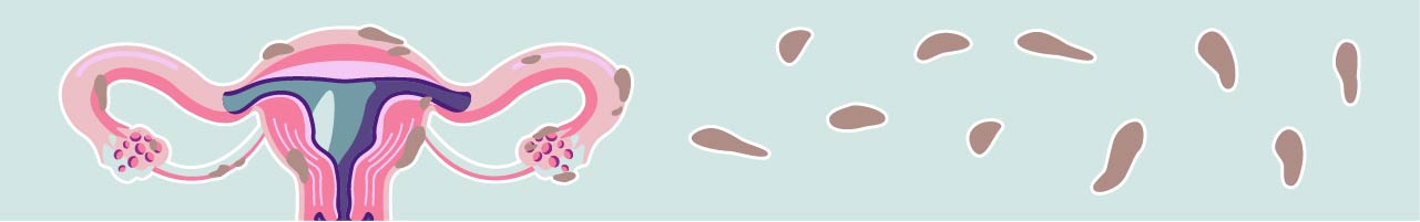 Endometriosis